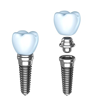 Dental Implants in Springfield, MA